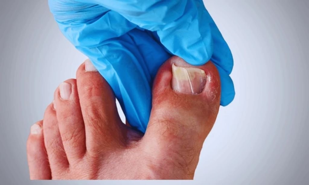 ingrown toenails treatment near you