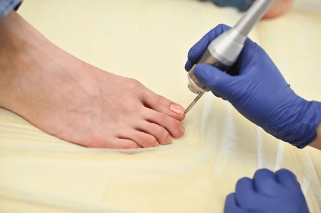 laser therapy for toenail fuonngus in valrico fl