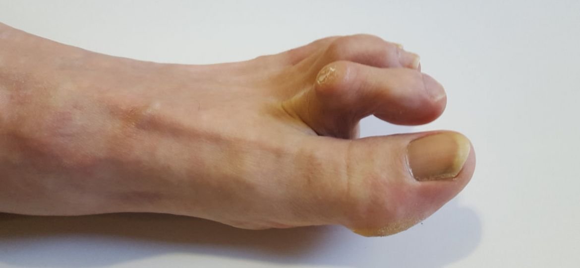 non-surgical treatment for hammertoes what you need to know