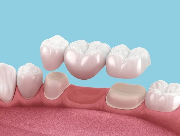 dental bridges near you