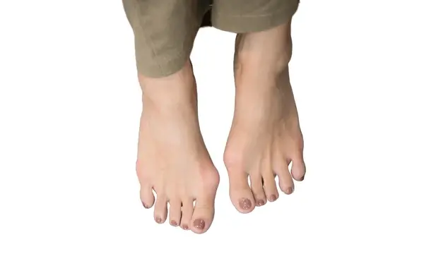 bunion correction in orlando and kissimmee, fl