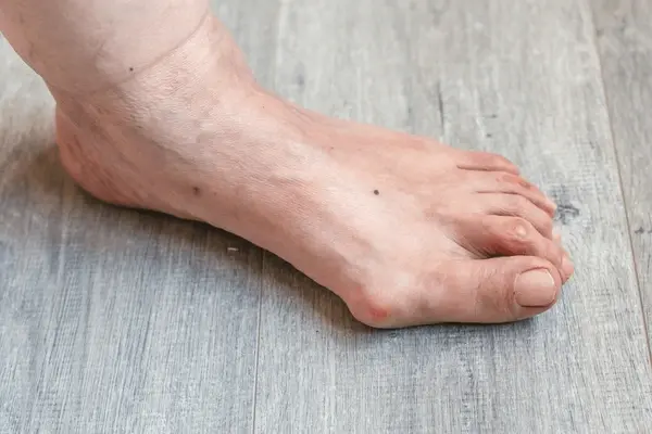 bunion correction near you