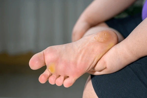 callus removal in orlando and kissimmee, fl