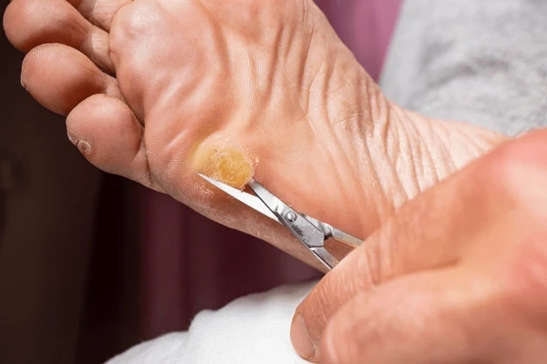 callus removal near you