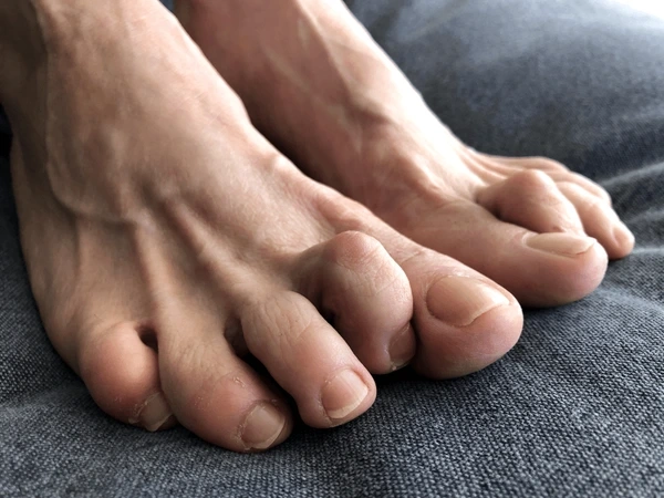 hammertoe correction in orlando and kissimmee, fl