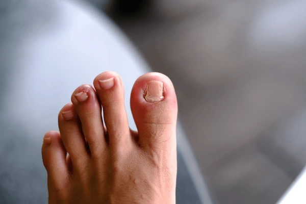 ingrown toenail treatment in orlando and kissimmee, fl