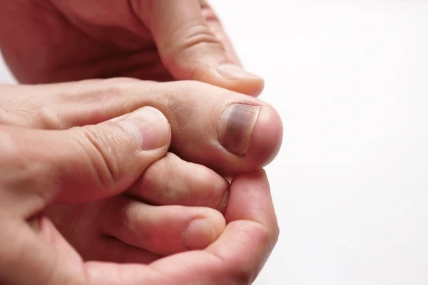 toenail fungus treatment in orlando and kissimmee, fl