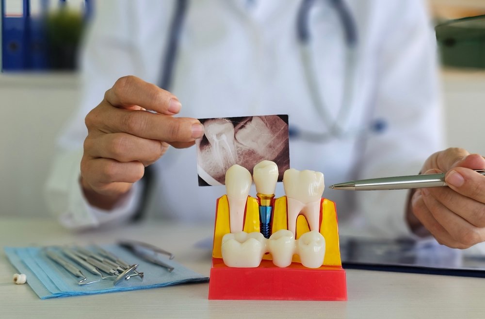 A dentist smiling and consulting with a patient about dental implants, while pointing to a digital scan of the patient's mouth. The scan shows the implants being digitally placed. No text on the image.