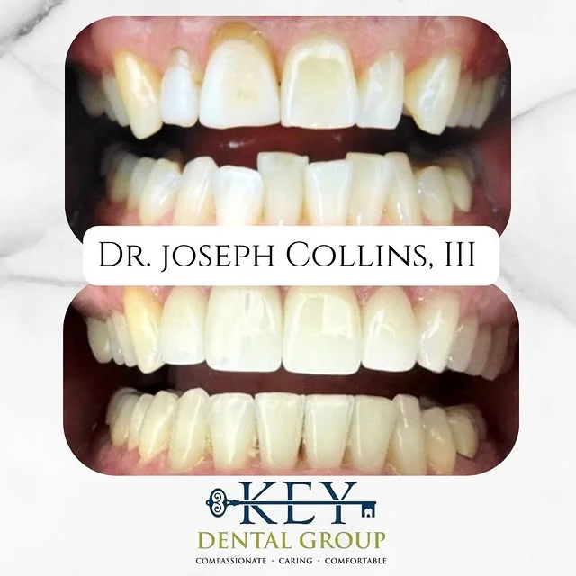 teeth whitening results at key dental group