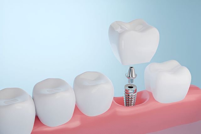 dental implants near you