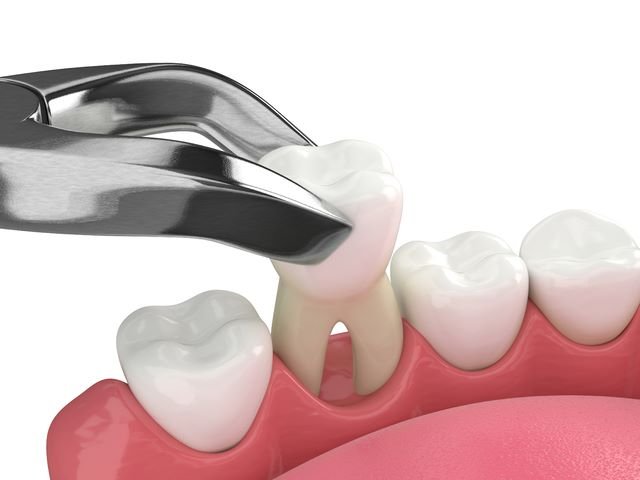 wisdom tooth extractions in st. catharines, on