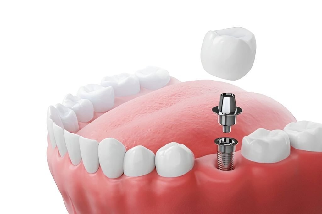dental implants landsdale on