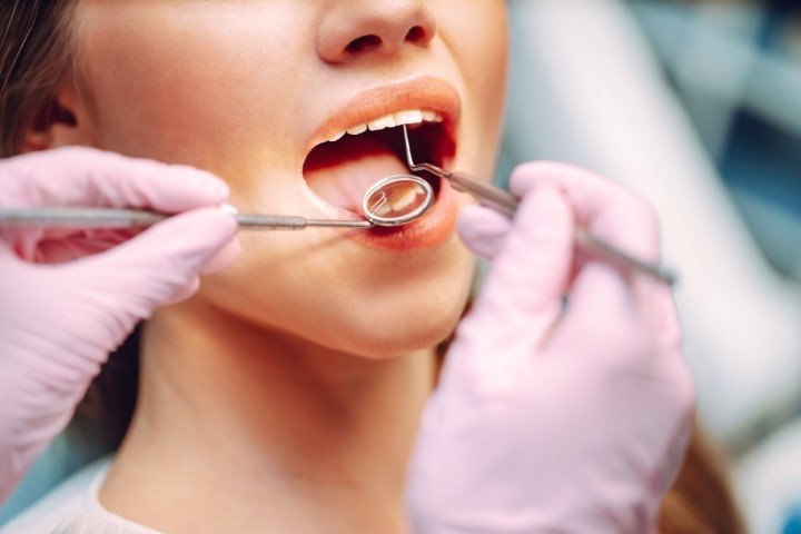 what are cavities a simple guide to understanding tooth decay