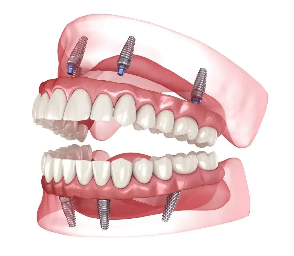 all on x dental implants in park ridge il