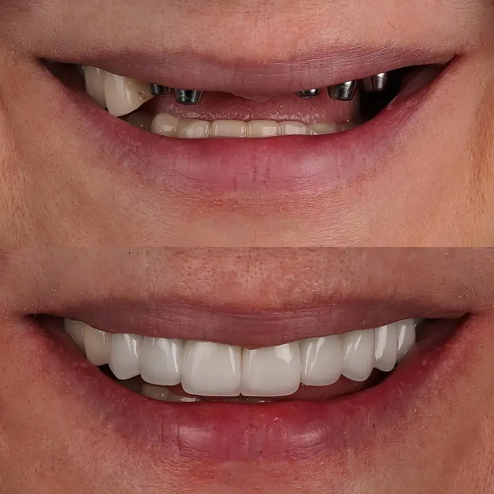 all on x dental implants near you