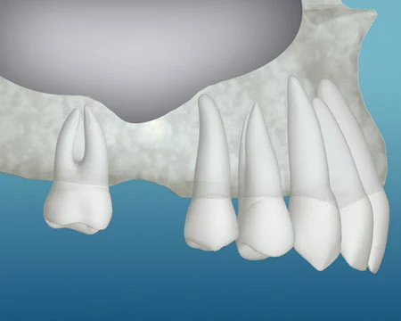 bone grafting for dental implants in park ridge il