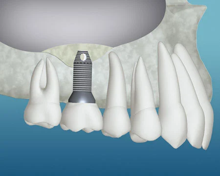 bone grafting for dental implants near you