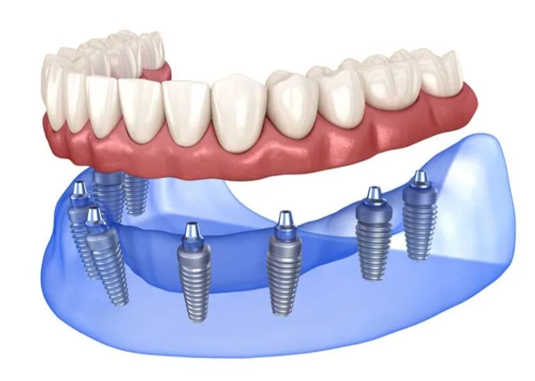 full arch dental implants in park ridge il
