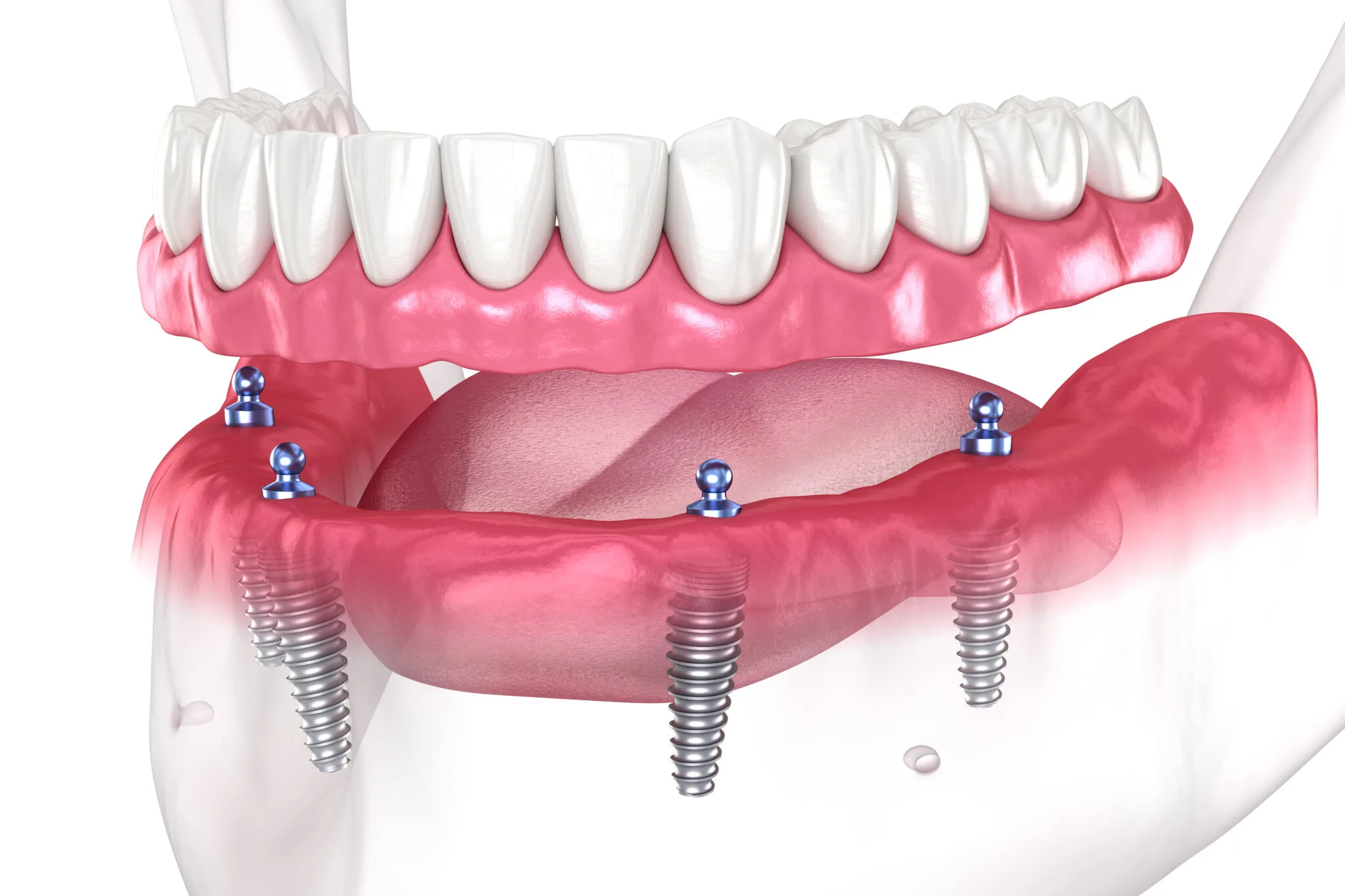 full arch dental implants near you
