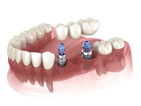 dental bridges near you