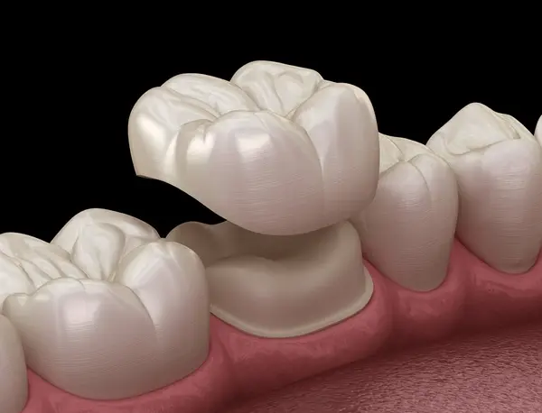 dental crowns near you