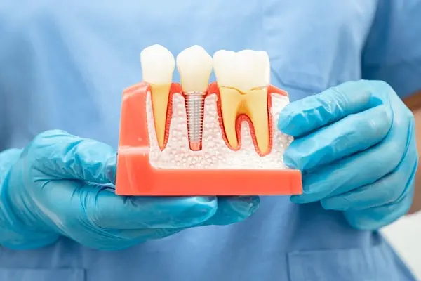 dental implants in downtown toronto on