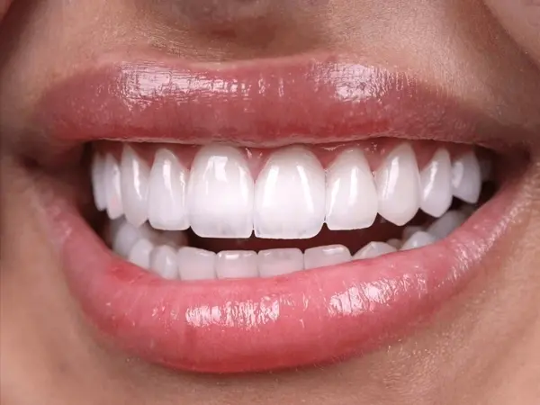 dental veneers near you