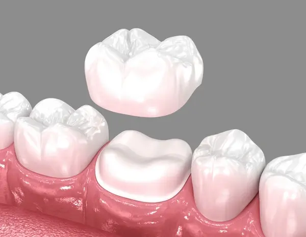 same day crowns in downtown toronto on