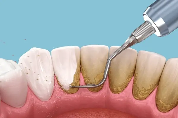 teeth cleaning near you