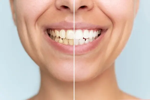 teeth whitening near you