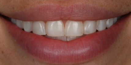beautifully aligned smile after dental treatment