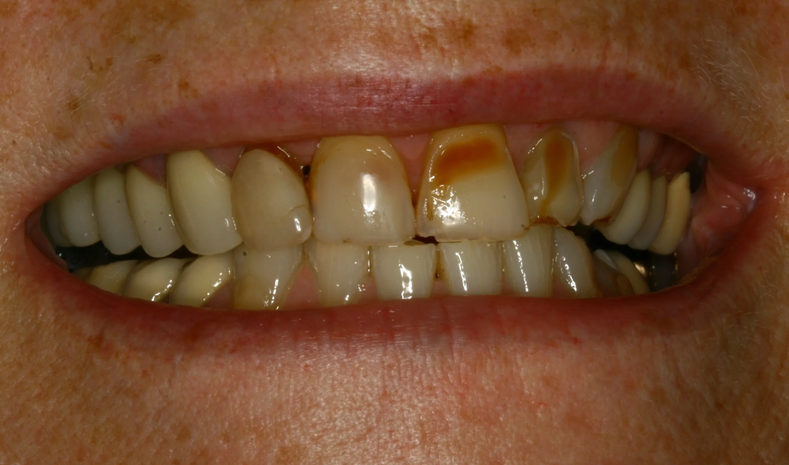 broken front tooth before repair treatment