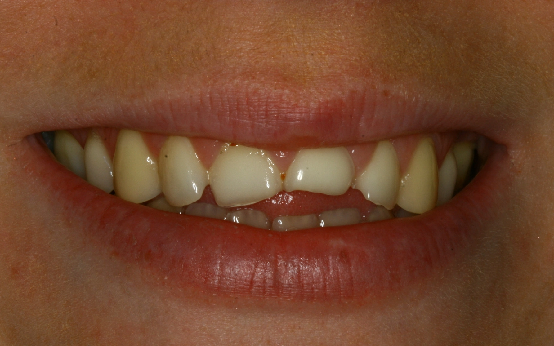 chipped teeth before restoration treatment