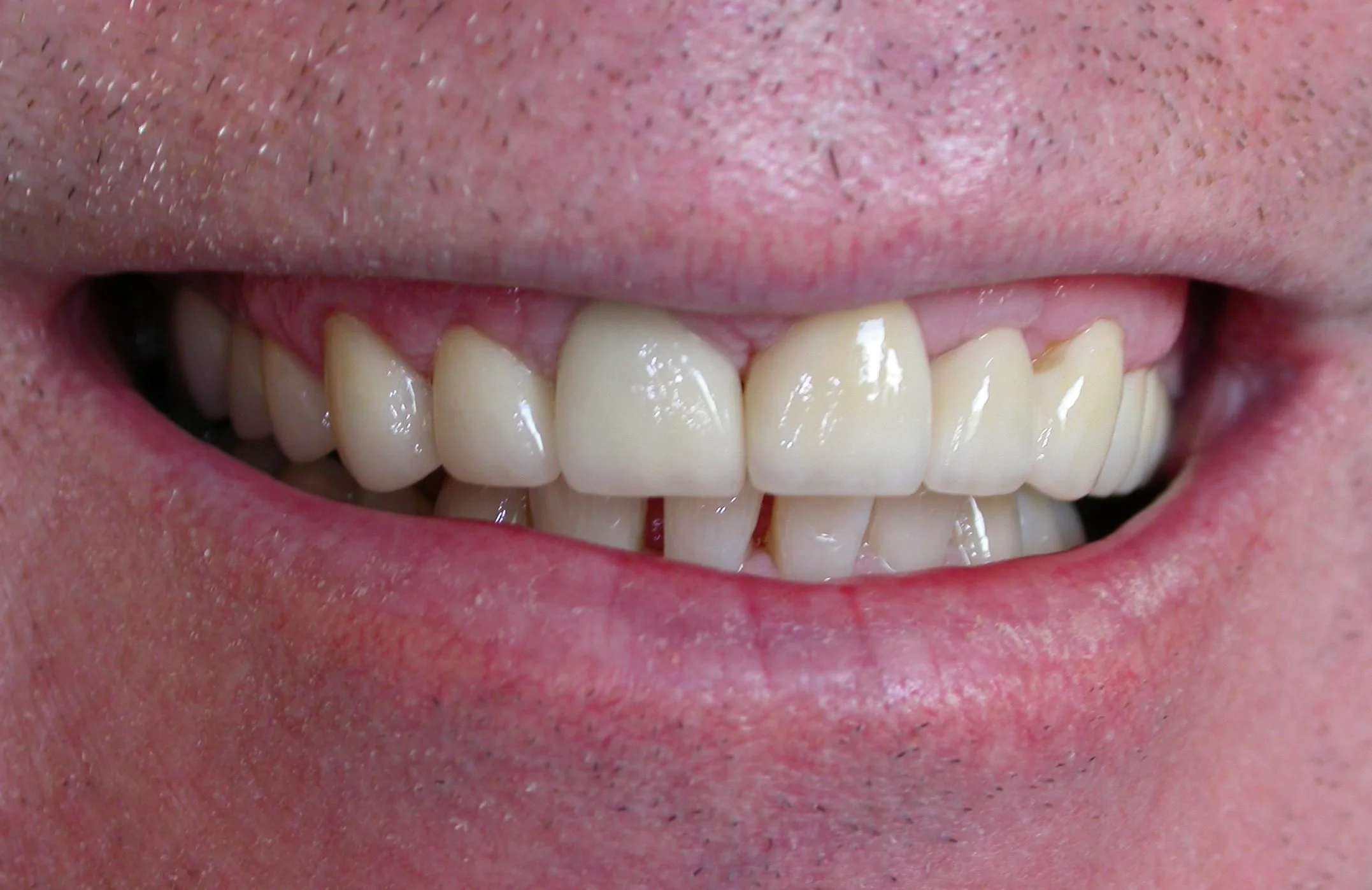 closed tooth gaps after orthodontic treatment