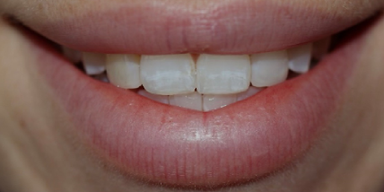 crooked smile before dental treatment