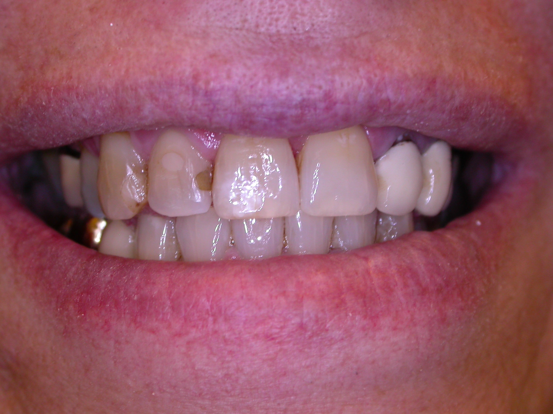 crowded teeth before corrective treatment