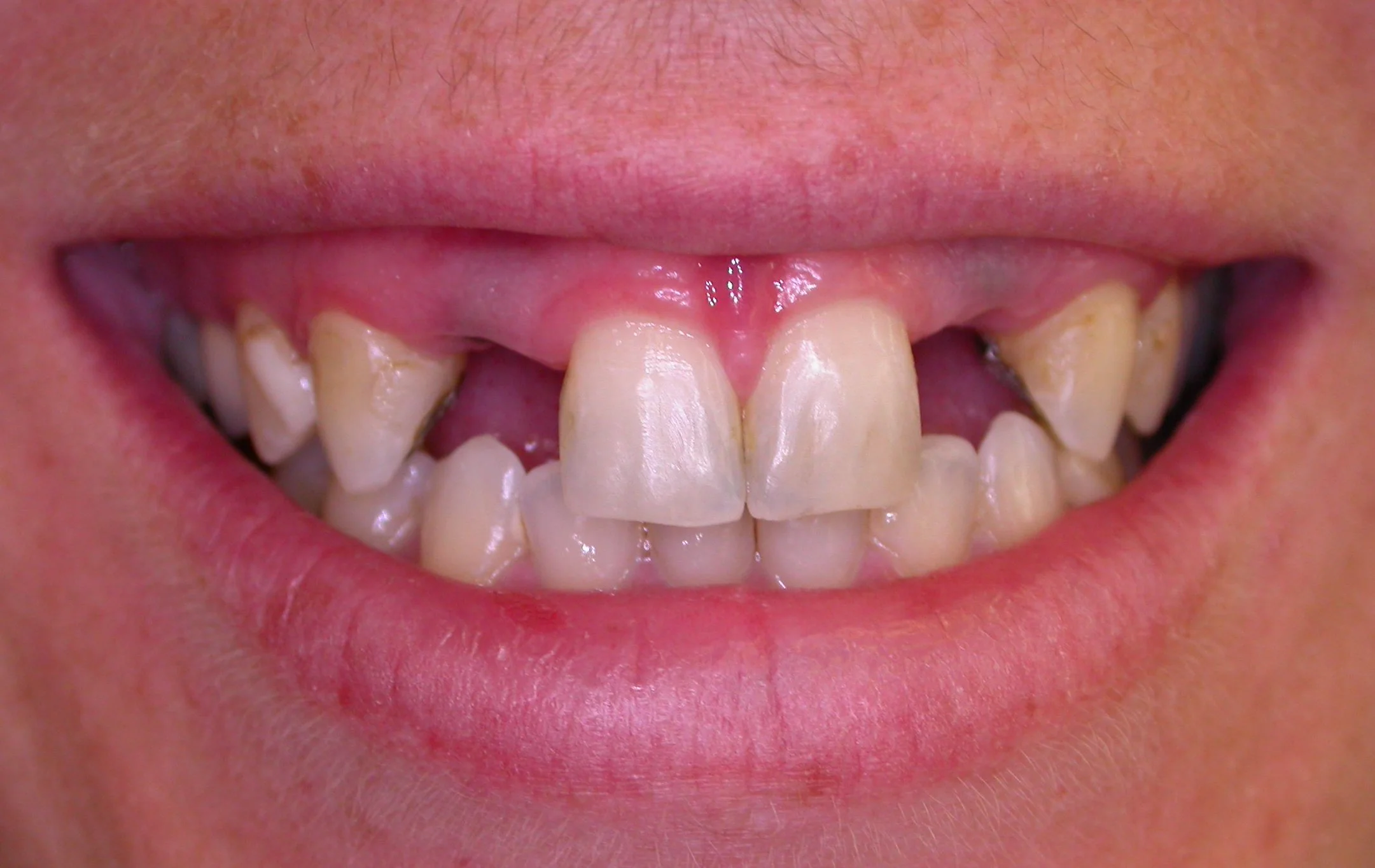 dark staining before whitening treatment