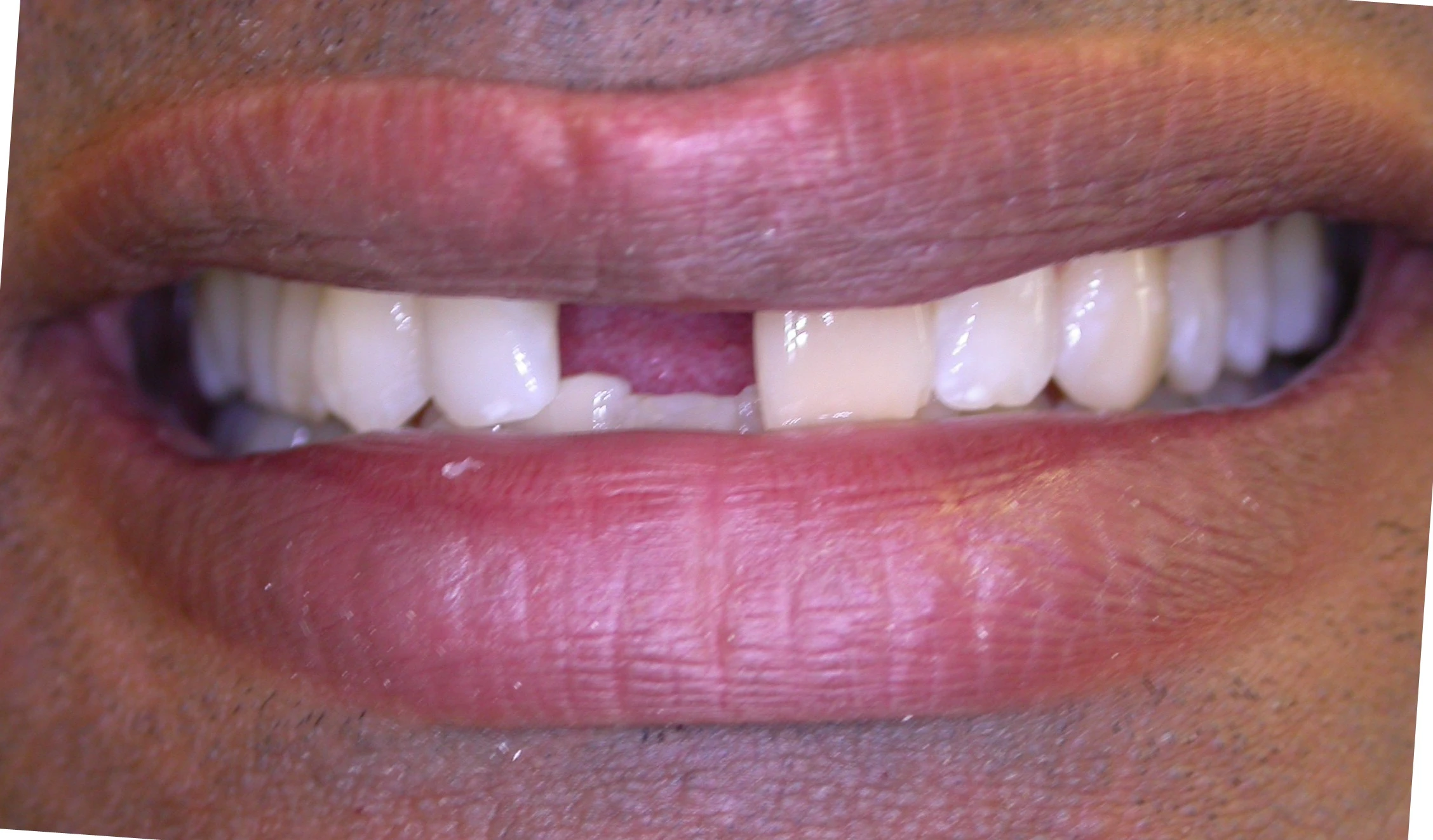 dental imperfections before aesthetic treatment