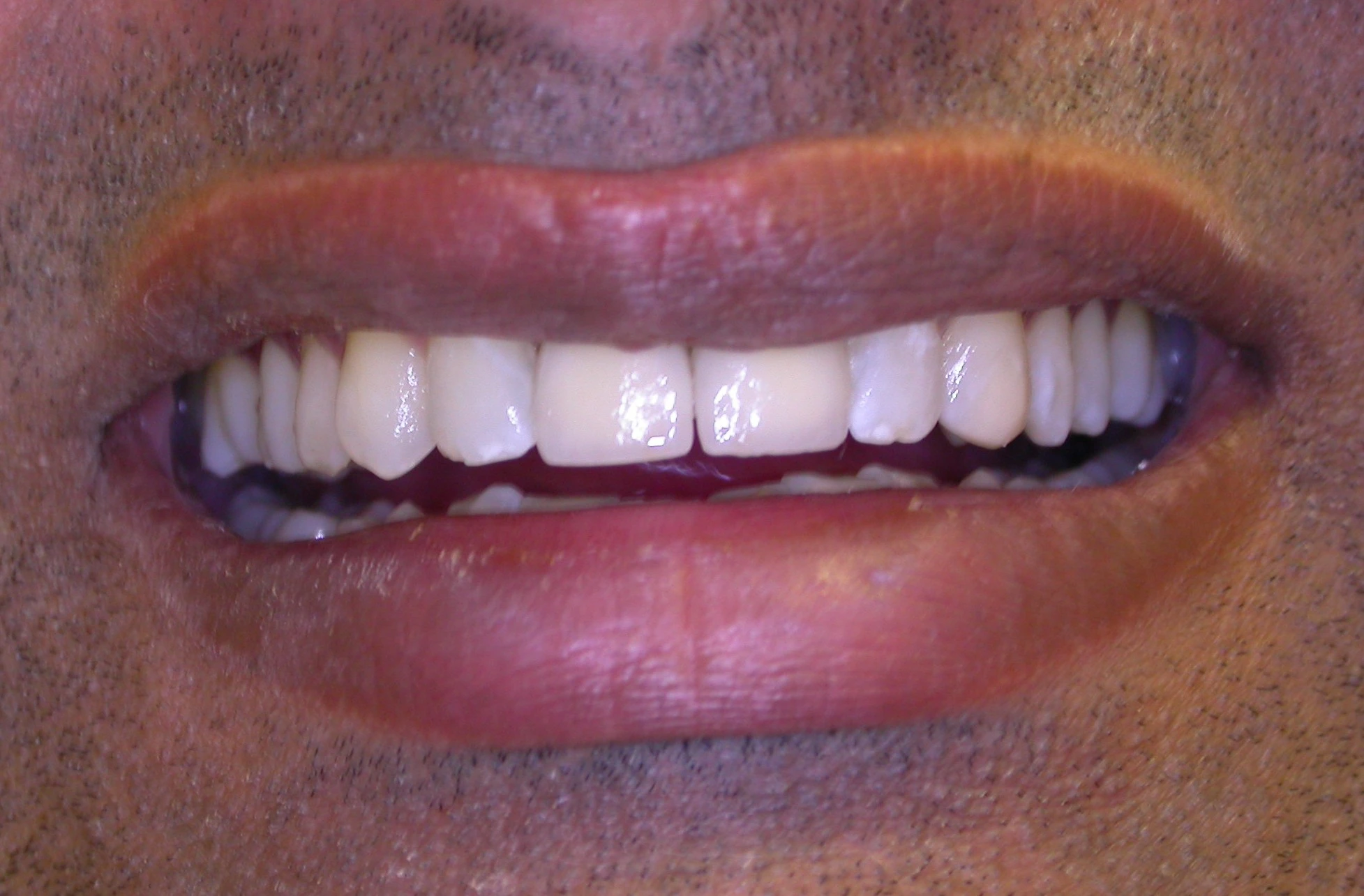 flawless smile makeover after aesthetic treatment