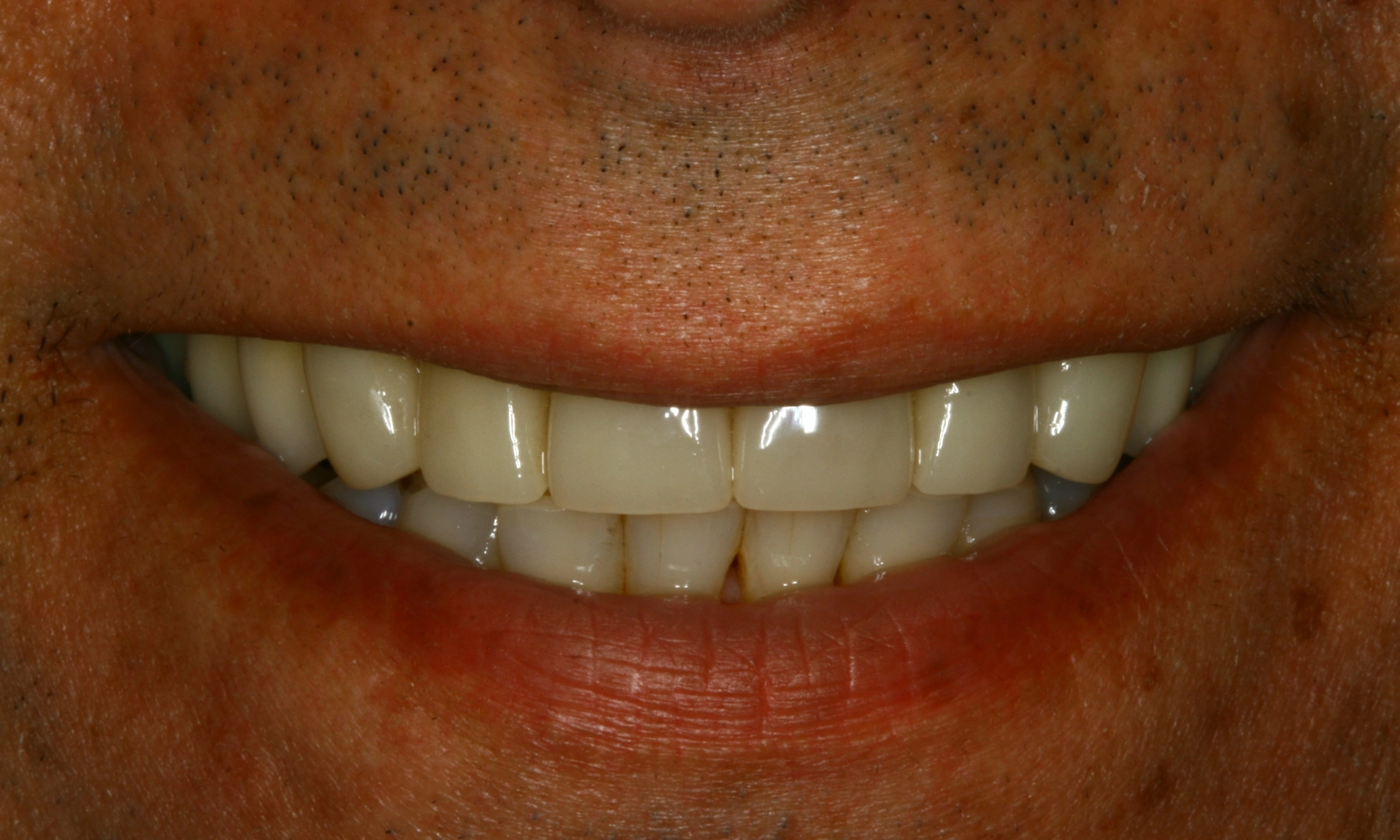 flawless veneers after dental treatment
