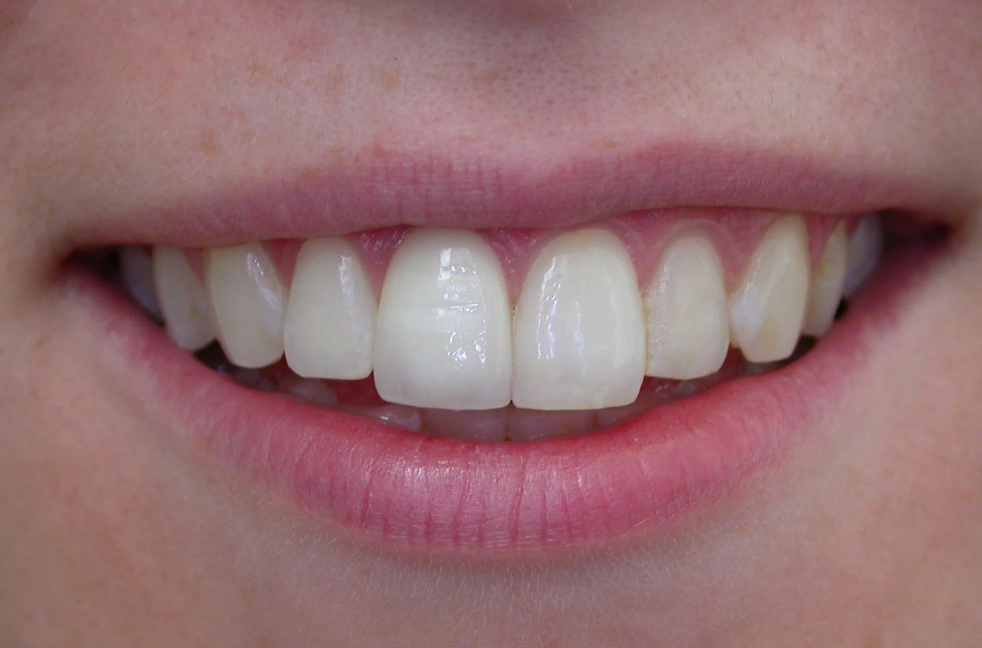 full mouth reconstruction after rehabilitation treatment