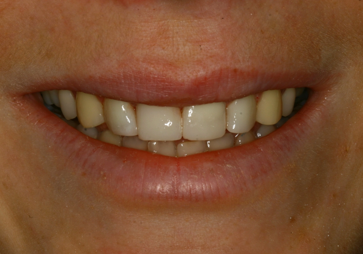 fully restored smile after restoration treatment
