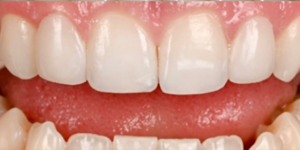 healthy smile after treatment