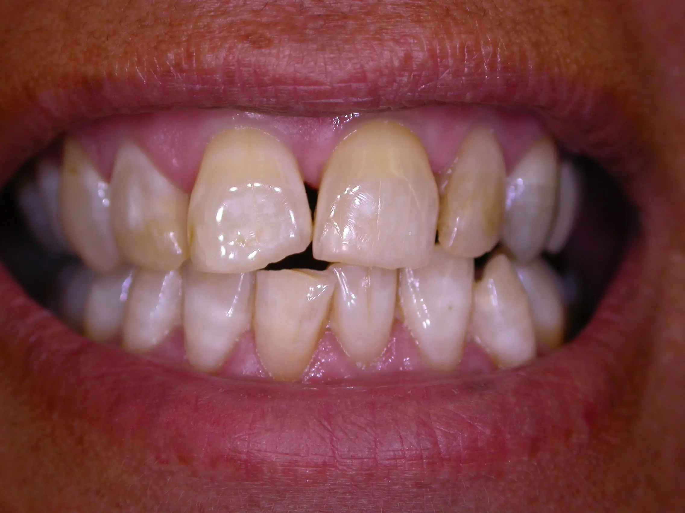 misaligned bite before advanced orthodontic treatment