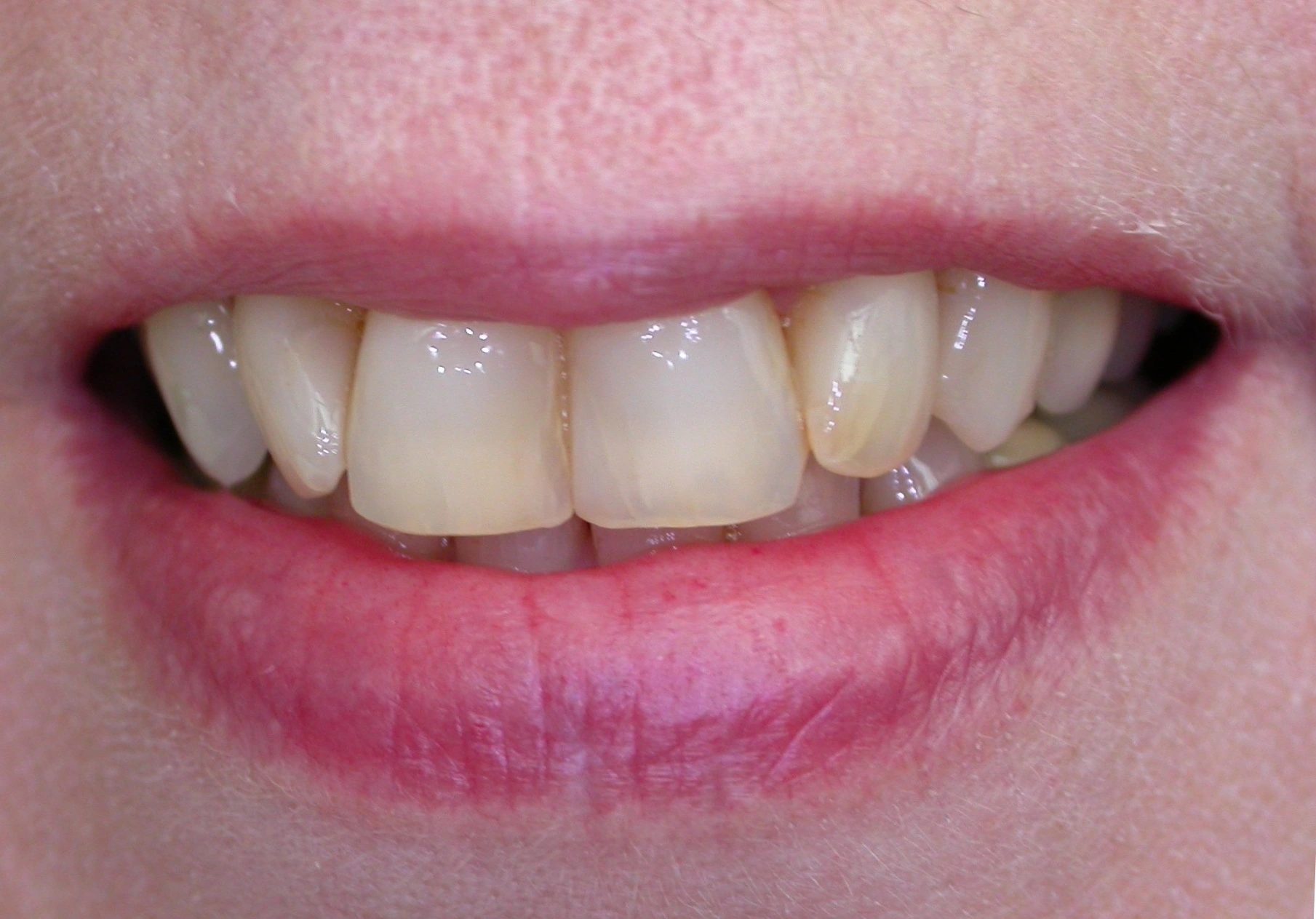 misshapen teeth before dental contouring