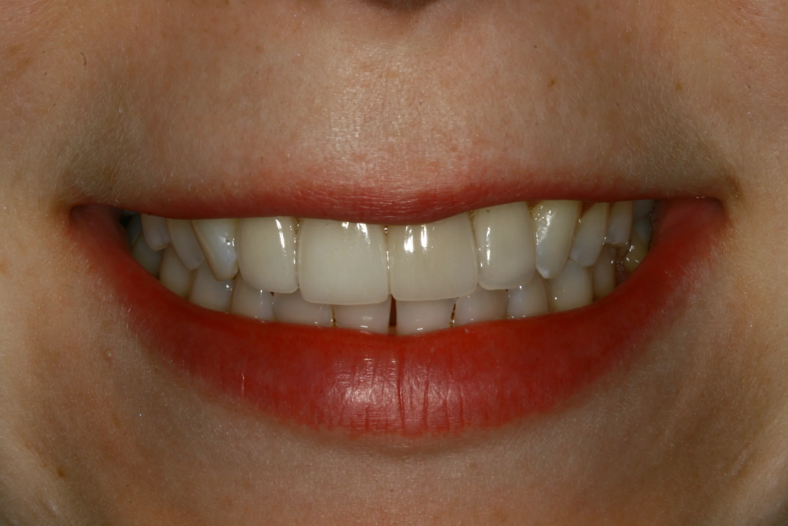 natural looking fillings after replacement treatment