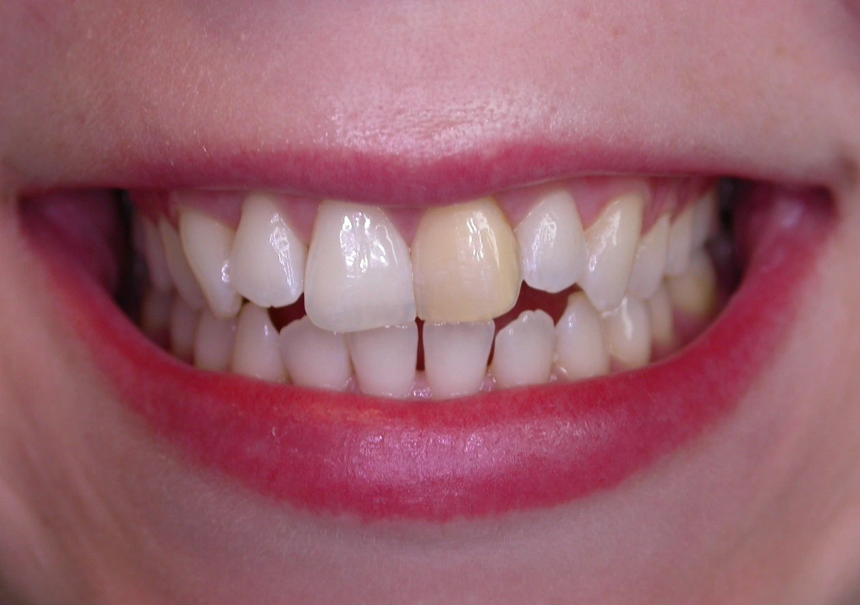 old metal fillings before replacement treatment