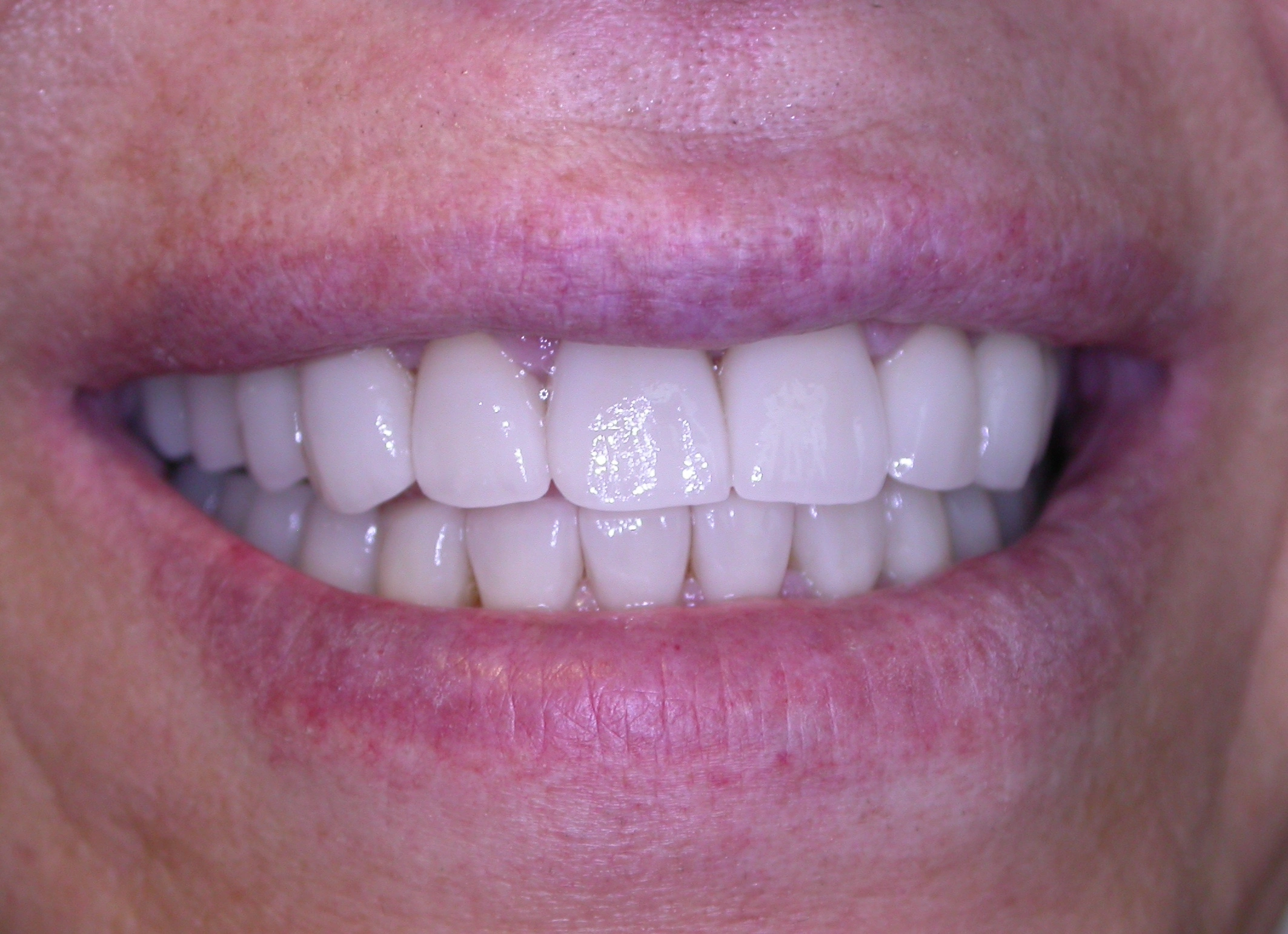 perfect tooth spacing after corrective treatment