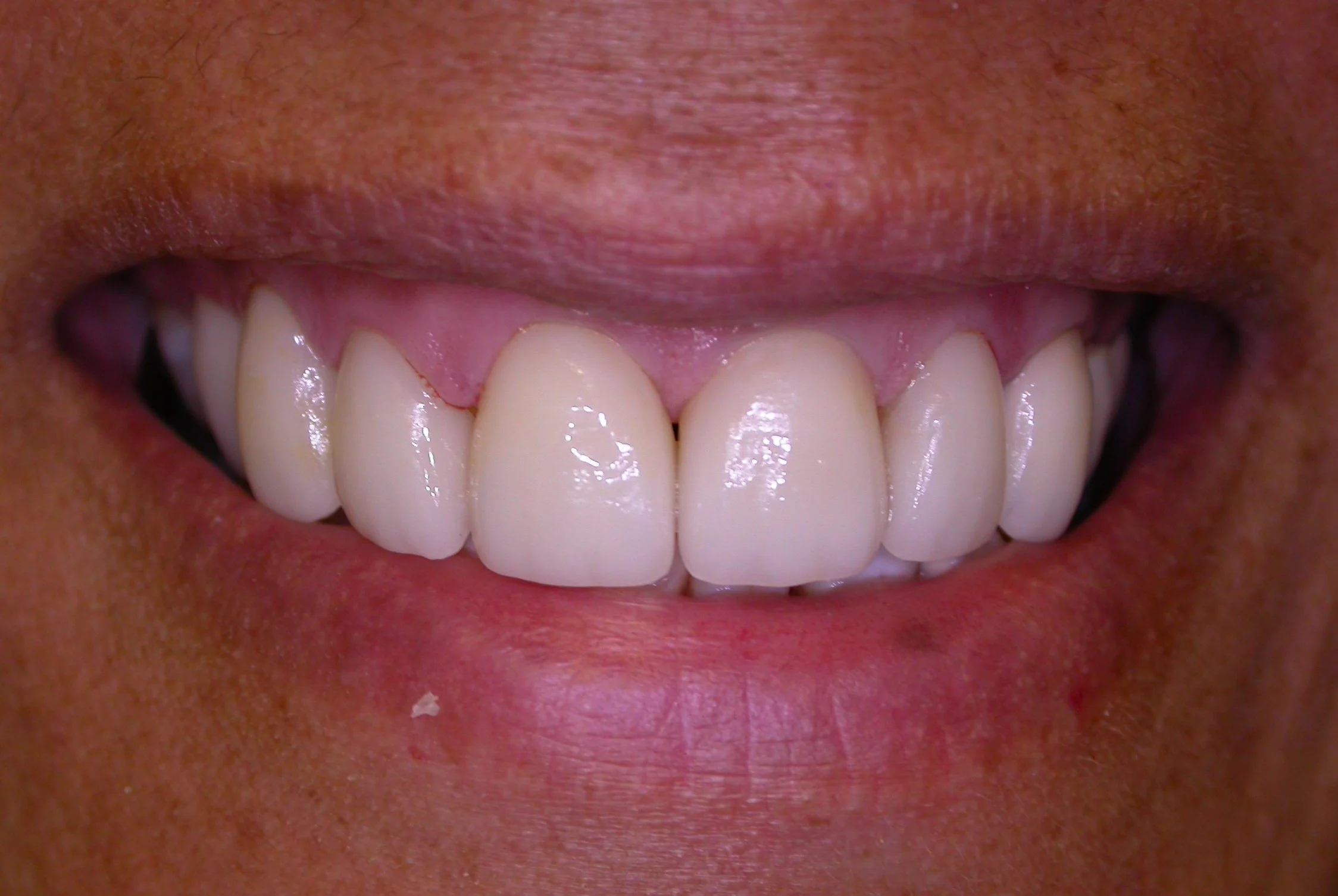 perfectly corrected bite after advanced orthodontic treatment