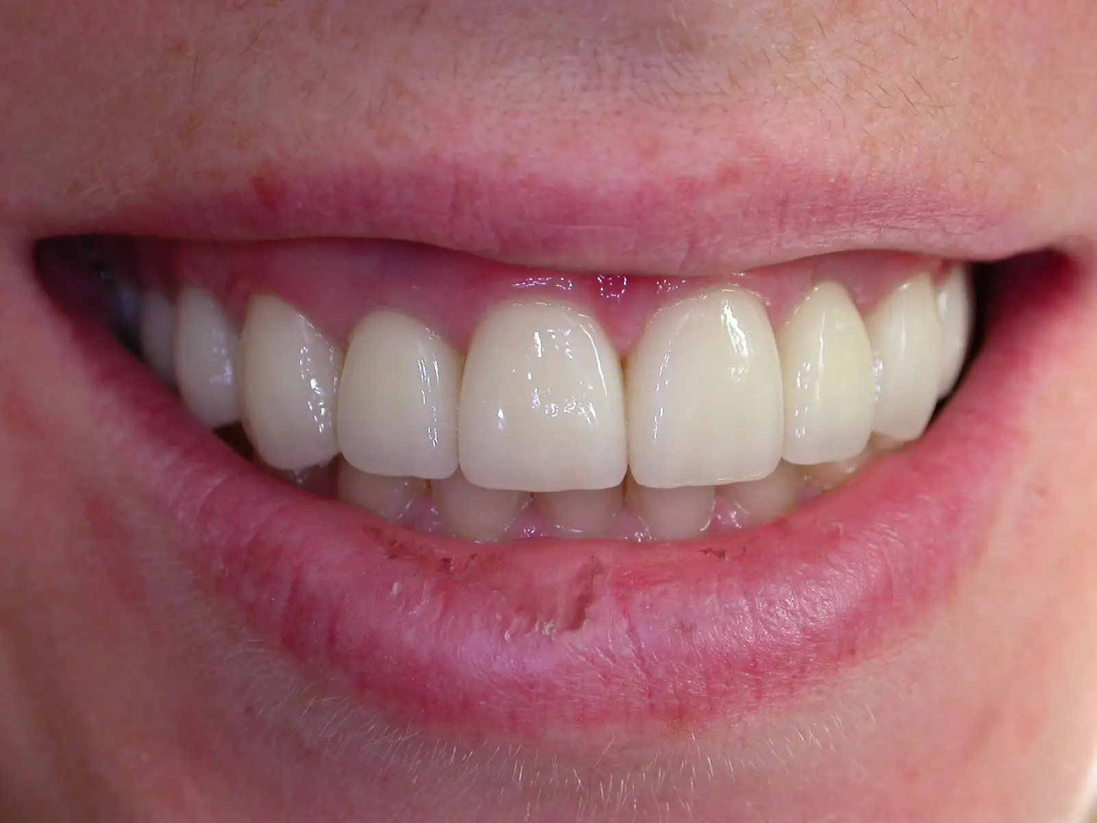 radiant white teeth after whitening treatment